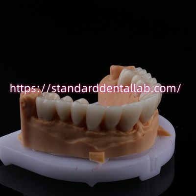 ซื้อ FDA ความสวยงามสูง สะพานซิกอร์โคนีฟัน ด้วยมงกุฎฟันซิกอร์โคนีฟันโพรเซลีนชั้น การผลิตออนไลน์