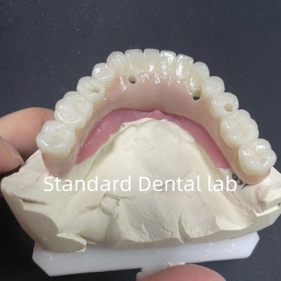 การฟื้นฟูความสวยงาม ทั้งหมดบน 4 การปลูกฟัน Zirconia Hypo อาการแพ้