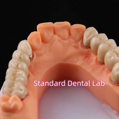 ดิจิทัล ไม่เป็นโลหะมีค่า Porcelain Crown PFM สะพานฟัน