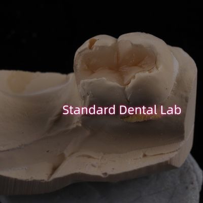 โปรเซลีนทองเหลือง Inlay Onlay Overlay Zirconia Emax ความสวยงามสูง
