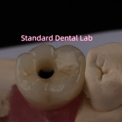 โครงการฝังหลัง Crown Bruxier สกรู Zirconia แข็งแรง