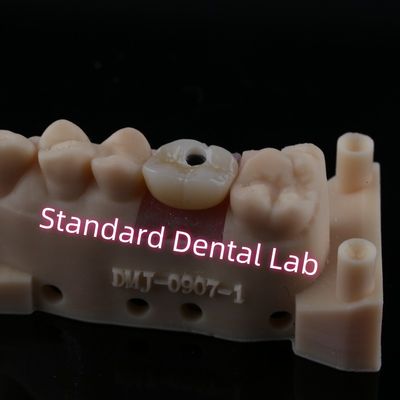 ปรับปรุง Abutment Implant Crown Full Contour สกรูซิกอนิยาที่เก็บไว้