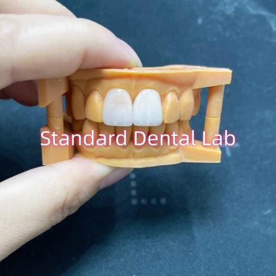 ความมั่นคงของสีสูง Ivoclar Emax Laminate Veneers ความโปร่งใสสูง
