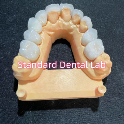 อีสเตติกสูงฮอลลีวู้ด ยิ้ม Milling Emax Laminate Veneers