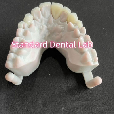 ฟันฟันยิ้มของดารา Emax Zirconia Laminate Veneers 0.6 มิลลิเมตร