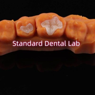 โปรเซลีนฟัน Inlay Onlay Overlay Zirconia Emax สารประกอบสําหรับฟันเสีย
