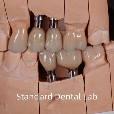 สีธรรมชาติดูสกรูยึดไว้ Zirconia ราชกุฎการปลูก
