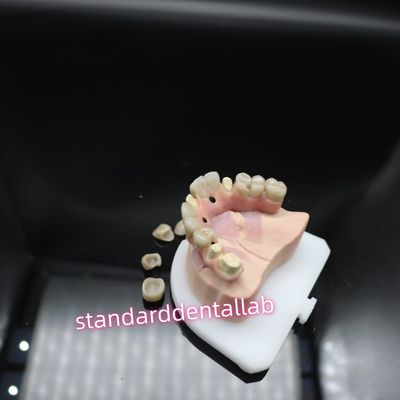 สะพานการปลูกฟันแบบดิจิตอล สะพานทิตาเนียม Ivoclar Hybrid Zirconia