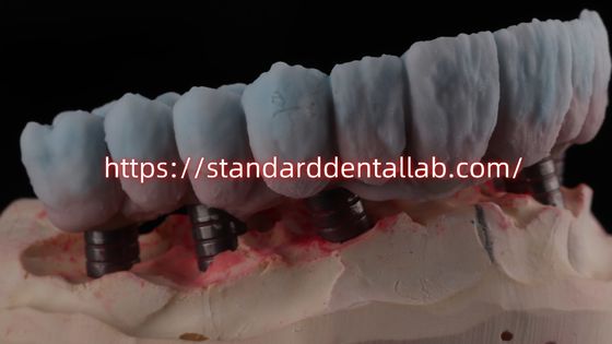 สะพานซิรคอนิยมที่รองรับการปลูกด้วย Titanium Abutment Esthetics สูง