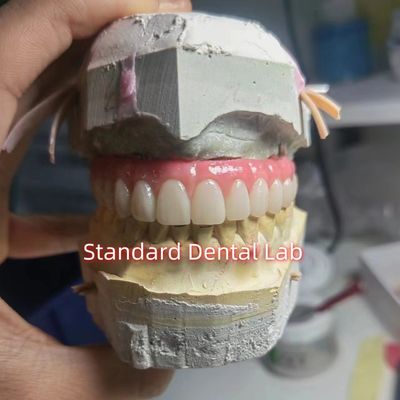 สกรูยึดทิตาเนียม PMMA สะพานฟัน รางชั่วคราว