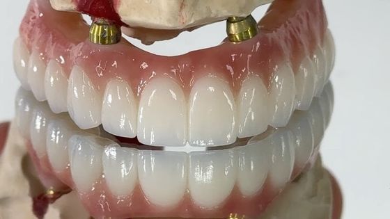ทันตแพทย์ All On X Implant PFM Crown Titanium Fixed Hybrid Denture การปรับปรุงฟัน
