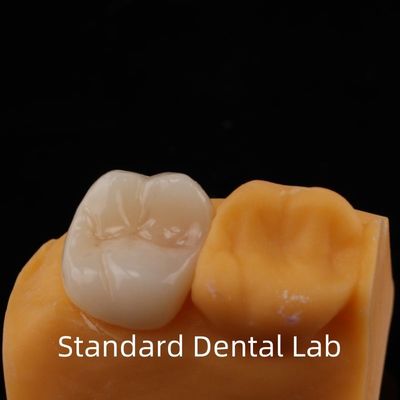 การรับประกัน 5 ปี ครอบคลุมครบ Zirconia Crown for Molar Teeth โนริทาเกะ โปรเซลีน ผลิตจากห้องปฏิบัติการทันตที่เชื่อถือได้