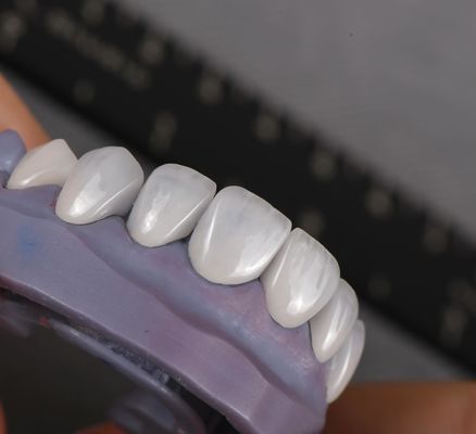 Emax Veneers ลายสีสีสีสีสีสีสีสีสี