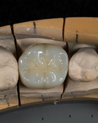 ครบวงจร Zirconia Crown การเปลี่ยนเร็วเพื่อให้เหมาะสมและสวยงามใน 1 สัปดาห์