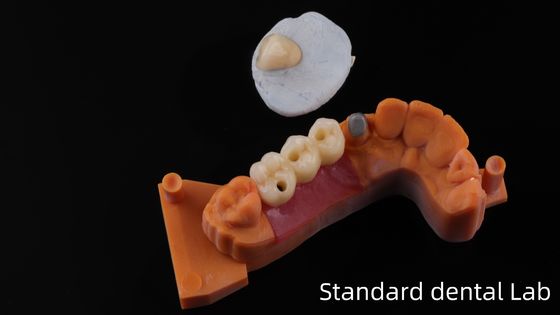 Post Core Dental Lab จากประเทศจีน / Metal Post Core พร้อม PFM Crown