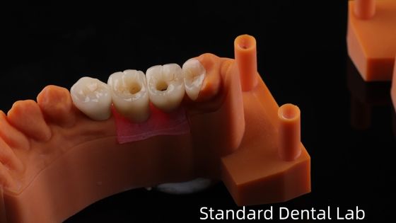 สกรูยึดมงกุฎการปลูกฟันด้วย PFZ โปรเซลีนชั้น Zirconia การันตี 5 ปีและรุ่นพิมพ์ 3 มิติ