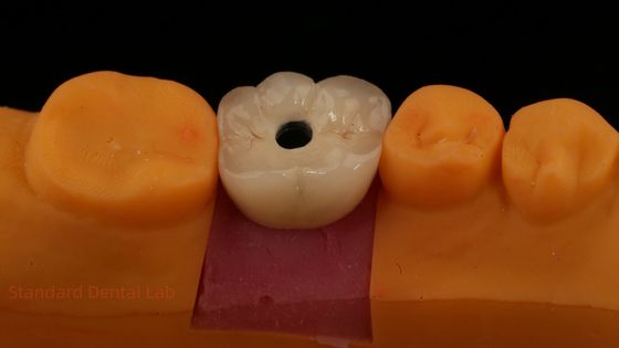 สกรูที่เก็บไว้ PFZ โปรเซลีนชั้น Zirconia รางวัลการปลูกฟันจากห้องปฏิบัติการฟัน ISO FDA CE รับรอง 5 ปี