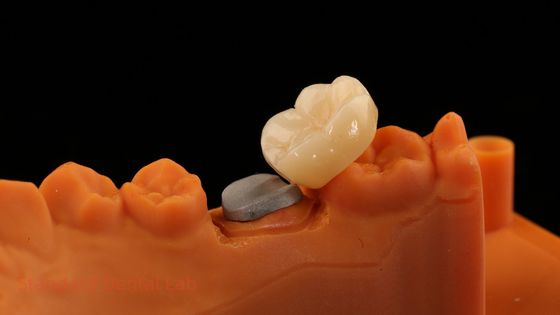 สวยงามสูงครบวงจร Zirconia Crown กับโลหะ Post Core รับประกัน 5 ปี และเทคนิคที่ดีกว่าจาก SDL ฟัน Lab
