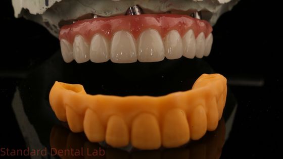 การรับประกัน 5 ปี ปลูกฟันมงคล PMMA Bridge Over Multi Unit Abutments Customized Vita Shade