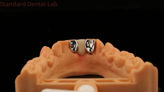 ฟันฟัน PFM Maryland Bridge ความสวยงามสูง FDA ได้รับการรับรองด้วย Vita Porcelian China Dental Lab