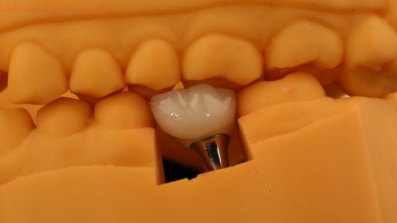 สกรูยึดยึดการปลูกฟัน Crown ฟัน PFM Crown กับรุ่นพิมพ์ 3D