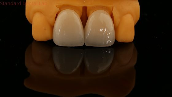 การรับประกัน 5 ปี ครบวงจร สี Zirconia Crown Customized Vita Shade สีสวยงาม สะพานฟันธรรมชาติ