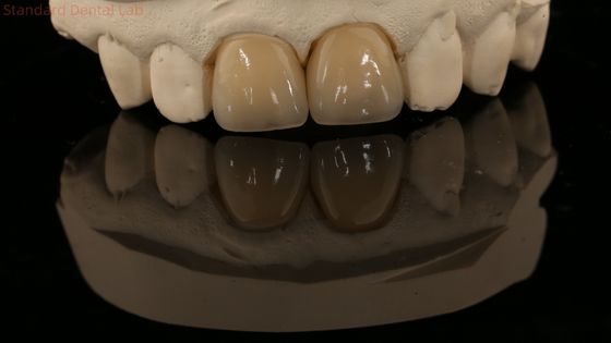 ครอบคลุมครอบคลุมครอบคลุม Zirconia และสะพานสีฟันธรรมชาติ 5 ปีรับประกัน