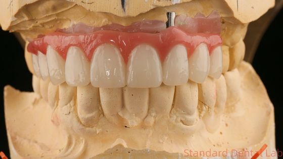 สวยเหมาะสม สีสวยงาม Zirconia Porcelain Crown สีชมพู Porcelain With Bleaching Shade
