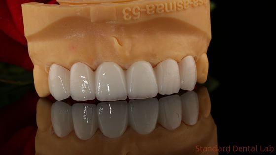 Full Contour Zirconia crown ทราสลูเซนซ์ 3D PRO ไม่มีโปรเซลิน Overlay สมาธิห้องปฏิบัติการฟัน
